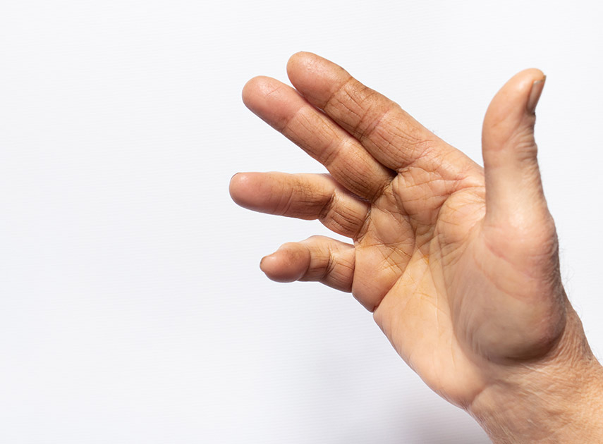 Human-hand-with-Dupuytren’s-Contracture