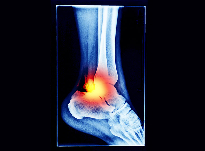 X-ray-of-ankle-in-pain