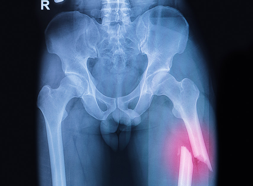 X-ray-scan-of-a-femoral-fracture