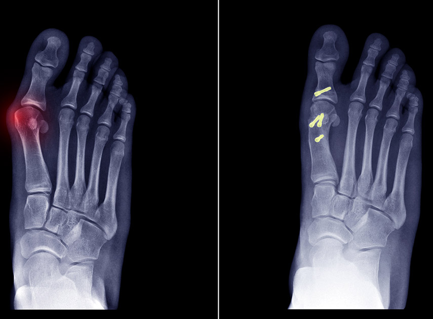 X-ray-scan-of-feet-with-bunions-before-and-after-surgery