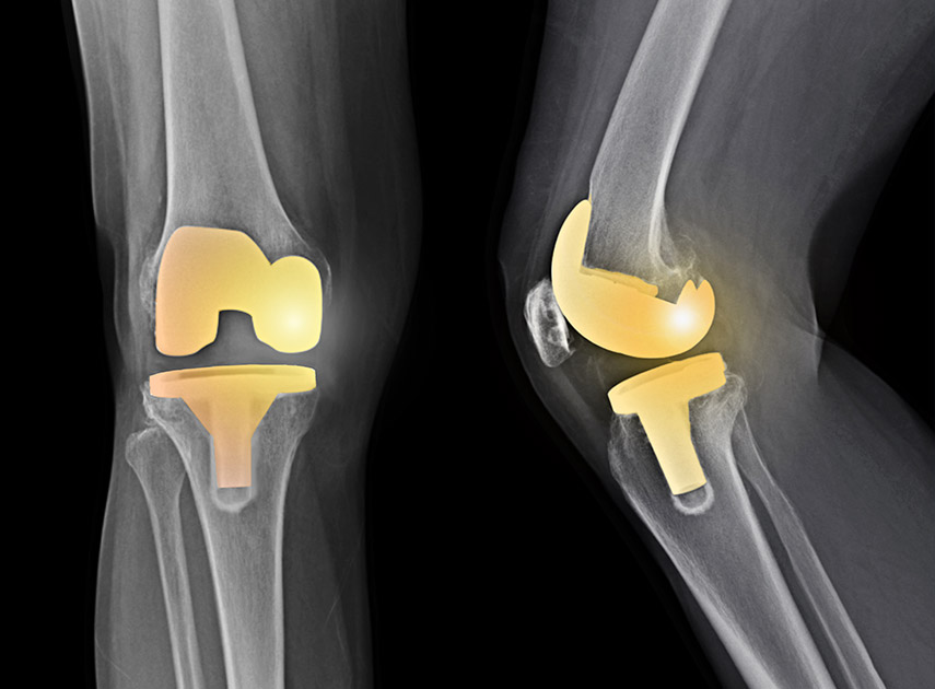 X-ray-scan-of-patient-who-has-undergone-total-knee-replacement