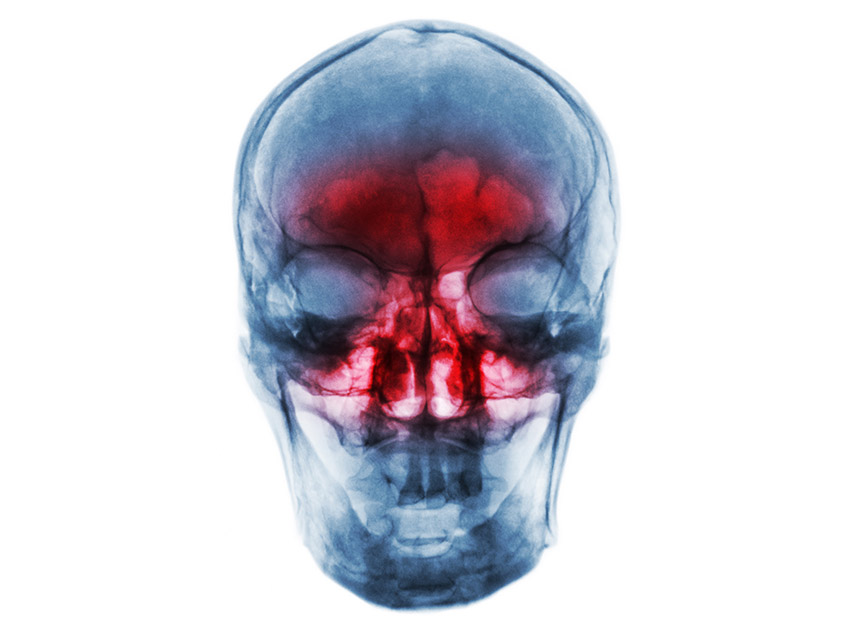 X-ray-scan-showing-inflamed-sinuses