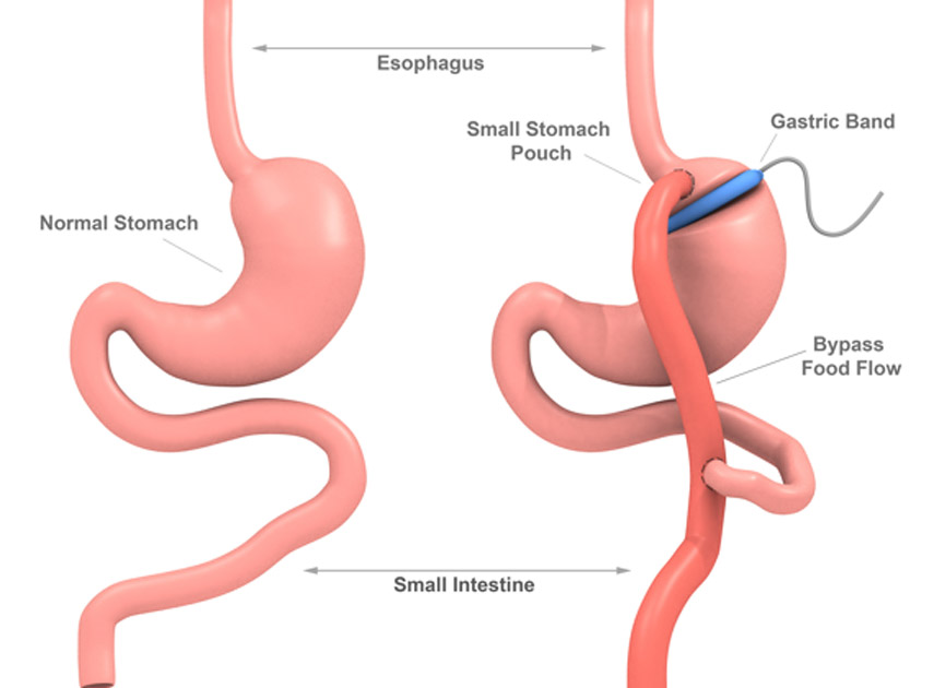 Illustration-of-gastric-band-surgery