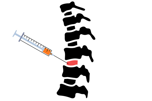 Epidural-Steroid-Therapy--Cervical,-Thoracic,-Lumbar-Spine